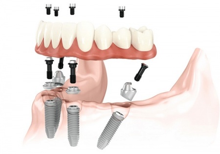 Имплантация зубов all on 4