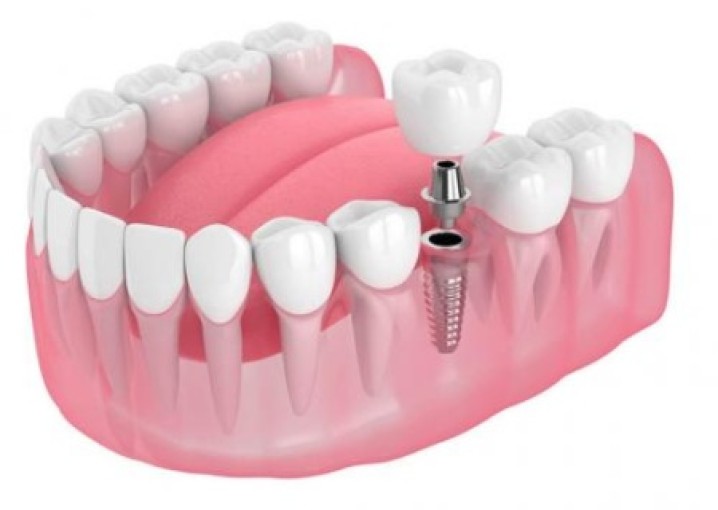 Имплантация зубов: особенности процедуры и выбор клиники в Астане