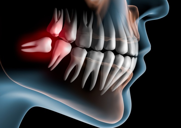 Почему зубы мудрости быстро разрушаются, и их рекомендуется удалять без лечения?